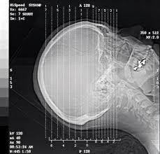 A imagem latente diagnóstica de prata do laser X Ray do alogenuro, A3/A4 Waterproof o filme da transparência