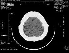 Bom preço 8 x 10 filmes de raio X de papel médicos Risco-resistentes para impressoras a laser de Konida on-line