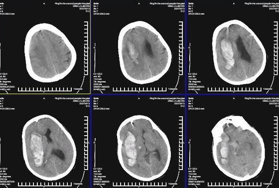 Bom preço Imagem latente diagnóstica médica impermeável KND-K de X Ray para a impressora a laser de Konida on-line