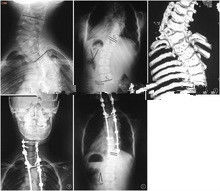 Imagem latente diagnóstica alta da cobertura X Ray da tinta, filme médico do raio de x do laser de 35 x de 43cm