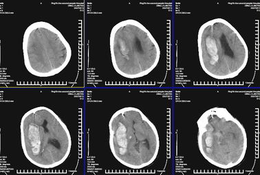 Good price Imagem latente diagnóstica médica impermeável KND-K de X Ray para a impressora a laser de Konida on-line
