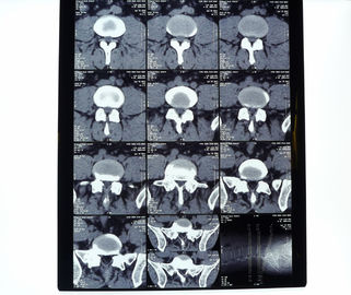 8in* 10in filme seco da impressora térmica do raio X médico high-density de 14in * de 17in