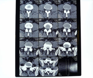 Good price 8in* 10in filme seco da impressora térmica do raio X médico high-density de 14in * de 17in on-line