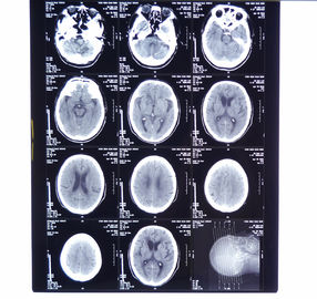 Good price 11in * a imagem latente médica seca do raio X de 14in filma KND-A para AGFA 5300, 5302, 5500, 5502, 3000 on-line