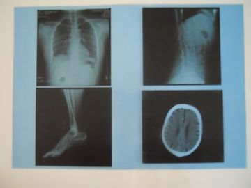 Good price Filme seco médico da imagem latente da baixa névoa de KND-A para o exame de X Ray em AGFA 5300/5302/5500 on-line